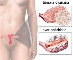 cancer ovarian